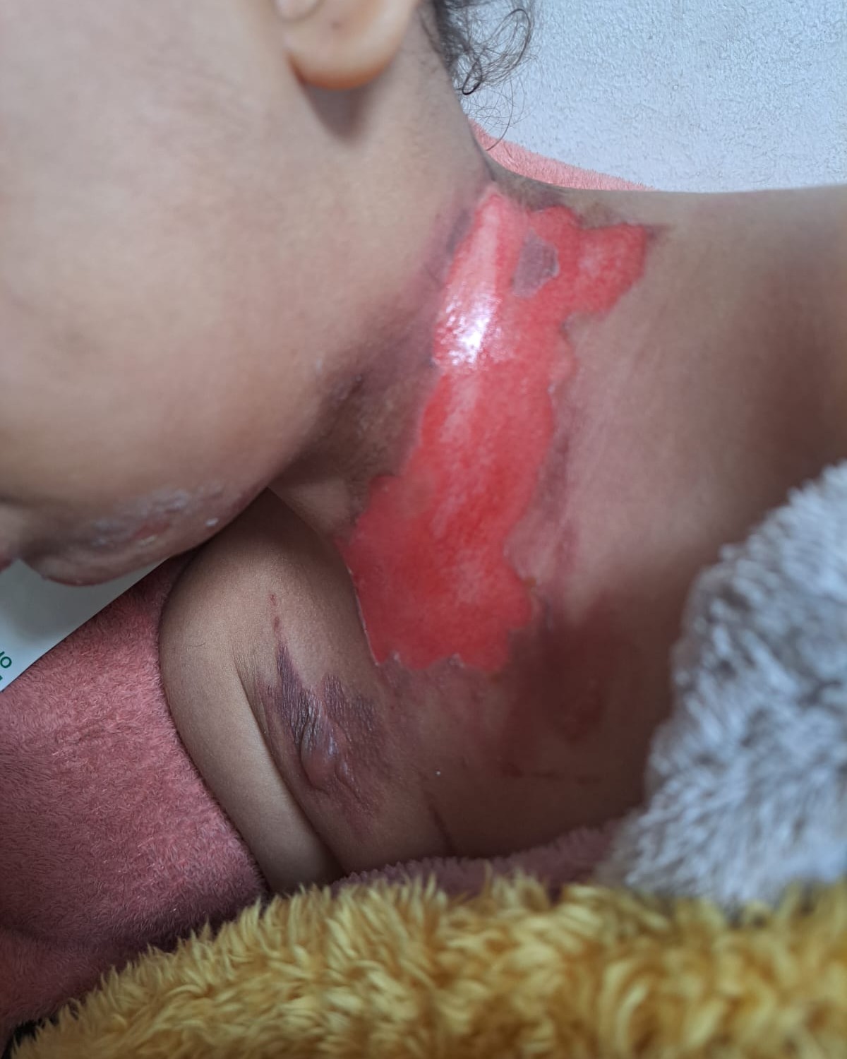 Severe neck injury on Masa — urgent medical need to help family in Gaza.