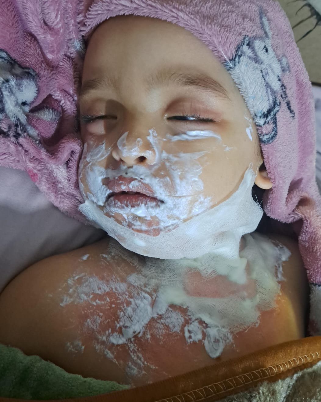 Masa receiving burn care — urgent need to help family in Gaza.