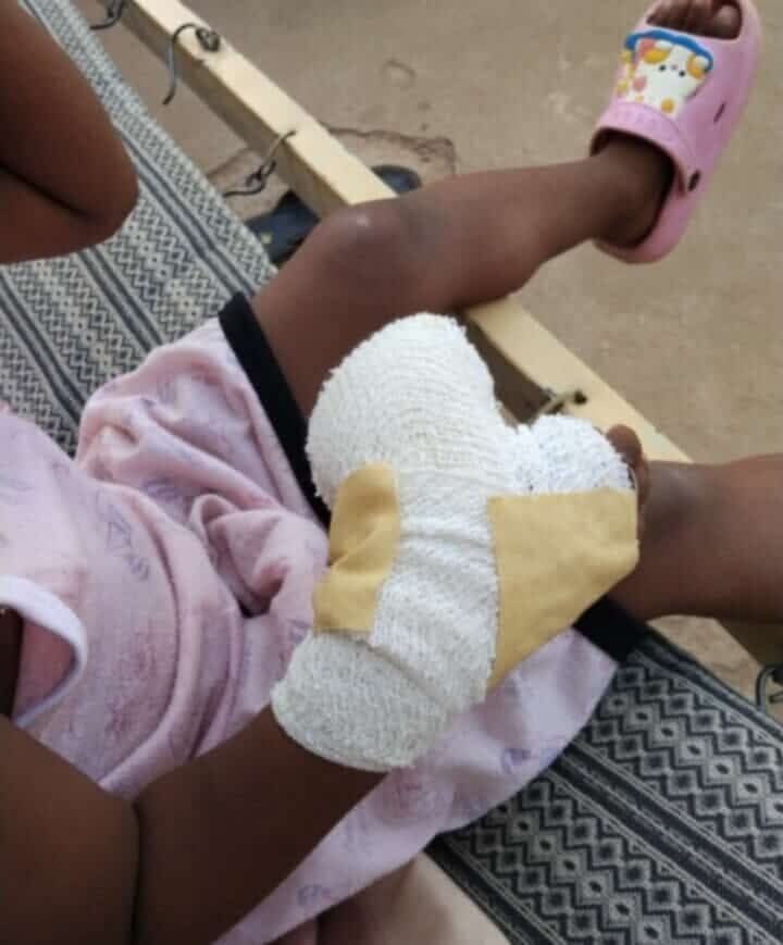 Medical Aid for Sudan Campaign Little girl in Sudan with bandaged hand needing medical aid.